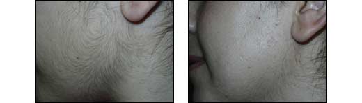 Before and After Hair Removal Photos