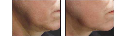 Before and After Redness Photos